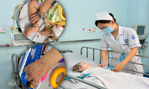 Gần 1/3 ca tay chân miệng nhập viện là ca nặng, bệnh viện dự phòng hơn 100 giường