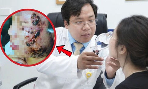 Tin lời sạch mụn sau 3 ngày, nữ sinh 20 tuổi mặt sưng nề 'như ong đốt'