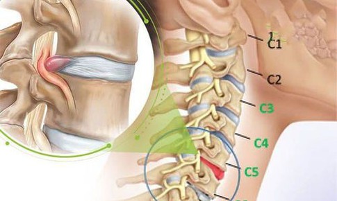 Tê tay khi ngủ chữa thế nào?