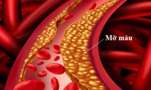 Mỡ máu cao âm thầm hại tim