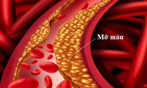 Làm thế nào để biết mình đang bị máu nhiễm mỡ?