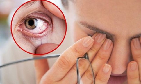 Chăm sóc người bị xuất huyết dưới kết mạc tại nhà