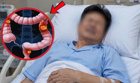 Đau mông kéo dài, người đàn ông 54 tuổi giật mình phát hiện ung thư