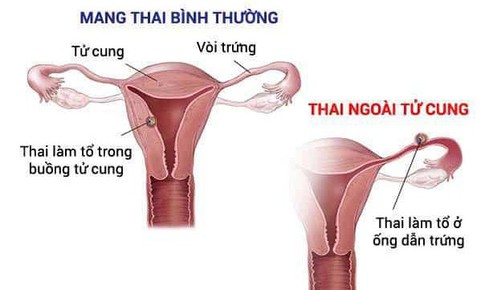 Thử thai 2 vạch, vì sao cần phải đi siêu âm sớm?