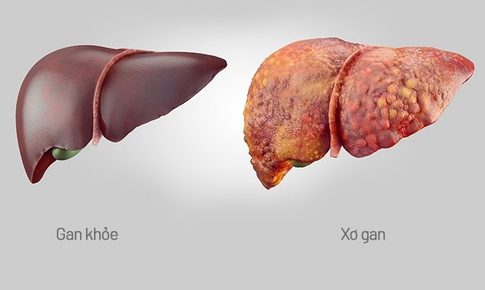 Lá gan sẽ 'mệt' thế nào nếu lạm dụng thực phẩm chức năng?