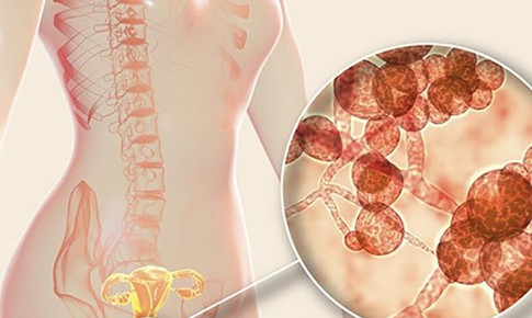 Mẹ bầu mắc nấm âm đạo nên uống thuốc hay đặt thuốc?