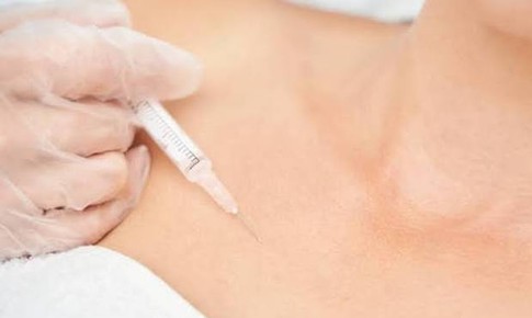 Ổ mủ xen lẫn filler trong ngực cô gái 24 tuổi
