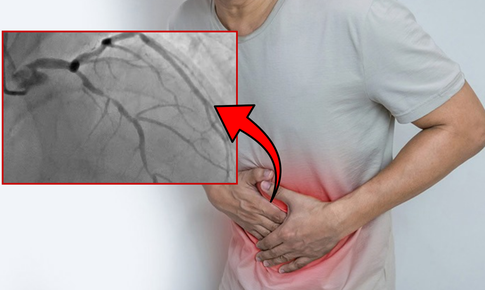 Đau thượng vị, người đàn ông phát hiện 3 nhánh mạch vành tổn thương nặng