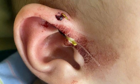 Lưỡi câu móc vào vành tai bé 10 tháng tuổi
