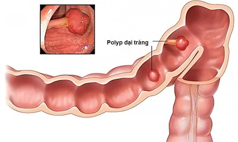 Polyp đại tràng được chẩn đoán như thế nào?