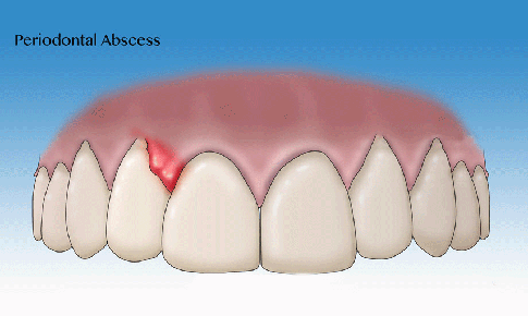 &#193;p xe nha chu – bệnh l&#253; răng miệng nguy hiểm thường gặp