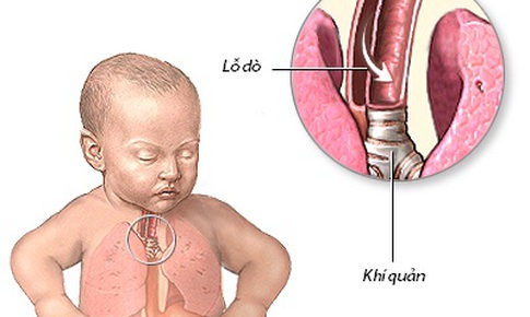 &#208;ể dị tật ti&#234;u h&#243;a kh&#244;ng đe dọa sự sống của trẻ