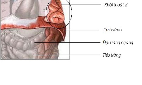 Tho&#225;t vị ho&#224;nh bẩm sinh - Tỉ lệ sống thấp, v&#236; sao?