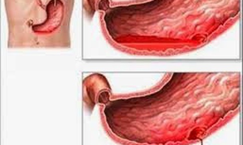 Thiếu m&#225;u do lo&#233;t dạ d&#224;y, c&#225;ch n&#224;o để trị?