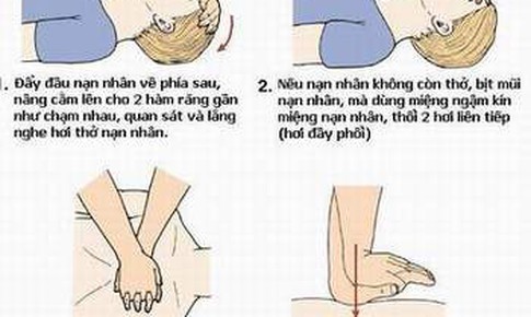 C&#225;ch h&#244; hấp nh&#226;n tạo v&#224; xoa b&#243;p tim ngo&#224;i lồng ngực