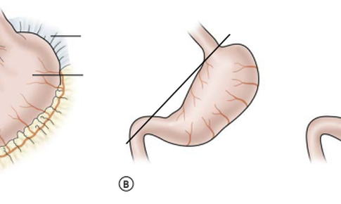 B&#233; trai 3 th&#225;ng tuổi mắc xoắn dạ d&#224;y hiếm gặp