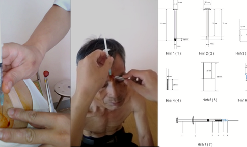 D&#249;ng bơm cấy chỉ trong phương ph&#225;p cấy chỉ gi&#250;p giảm đau cho bệnh nh&#226;n