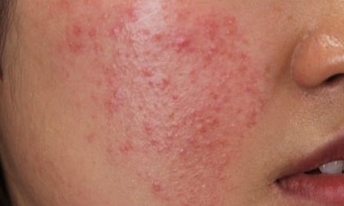 Nhận biết dị ứng mỹ phẩm