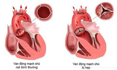 Ph&#242;ng ngừa bệnh l&#253; động mạch chủ- Nguy cơ tử vong cao