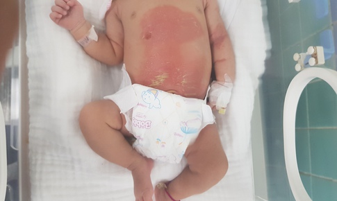 Bé 14 ngày tuổi bỏng nặng do chữa chướng bụng bằng lá trầu hơ nóng
