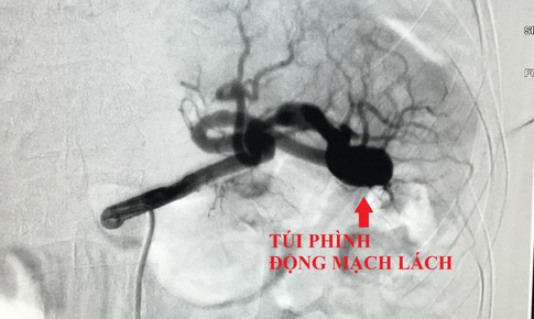 Đau bụng &#226;m ỉ 6 th&#225;ng người phụ nữ, ph&#236;nh động mạch l&#225;ch dọa vỡ