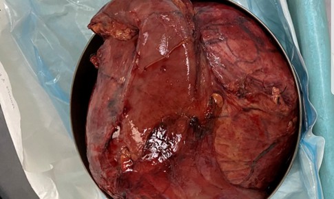 Tăng cân bất thường, cô gái không ngờ mang khối u hiếm gặp