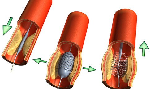 Bệnh nh&#226;n đặt stent động mạch v&#224;nh: V&#236; sao cần d&#249;ng kh&#225;ng tiểu cầu k&#233;p?