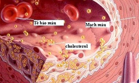 T&#225;c dụng phụ của statin trị mỡ m&#225;u: C&#226;n nhắc lợi &#237;ch v&#224; nguy cơ khi d&#249;ng