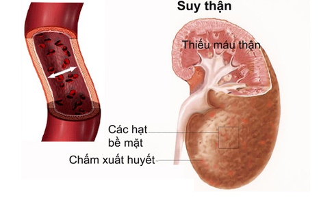 Cảnh gi&#225;c thuốc g&#226;y tổn thương thận cấp t&#237;nh