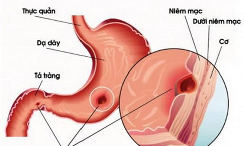 Dược thiện cho người vi&#234;m lo&#233;t dạ d&#224;y t&#225; tr&#224;ng