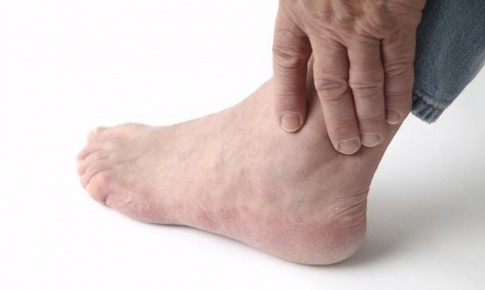 Dấu hiệu của bệnh gout