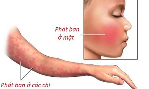 Phòng bệnh ban đỏ nhiễm khuẩn mùa xuân hè
