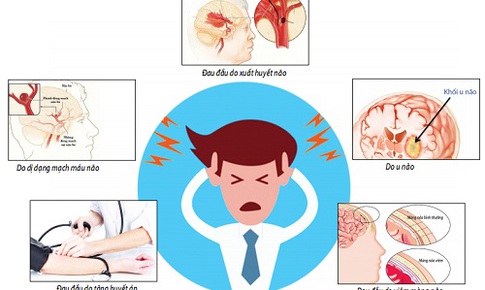 Nhận diện những cơn đau đầu nguy hiểm