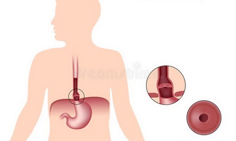 Hội chứng thu hẹp vòng thực quản: Một bệnh lý mới còn ít được biết đến