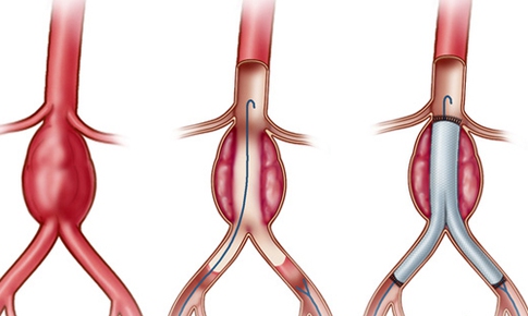 Phương ph&#225;p can thiệp động mạch chủ: “Cứu tinh” của người bị ph&#236;nh t&#225;ch động mạch chủ