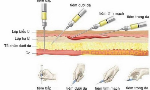 Xử tr&#237; phản ứng bất lợi thường gặp khi d&#249;ng thuốc ti&#234;m