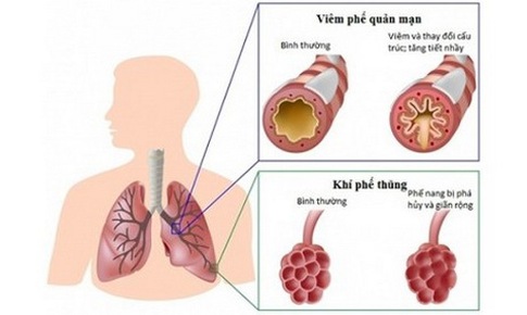 Bệnh phổi tắc nghẽn mạn t&#237;nh - “S&#225;t thủ v&#244; h&#236;nh”