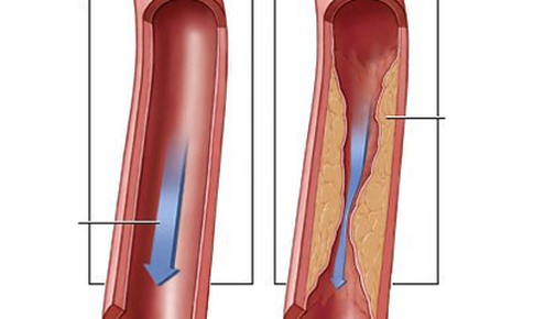 Xơ vữa động mạch chủ c&#243; ngừa được kh&#244;ng?