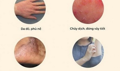 Chặn biến chứng do vi&#234;m da cơ địa