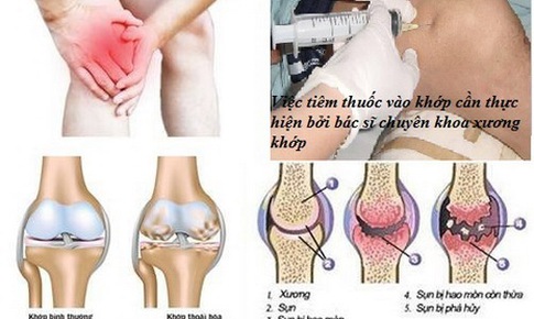 Những sai lầm khi d&#249;ng thuốc chữa bệnh xương khớp