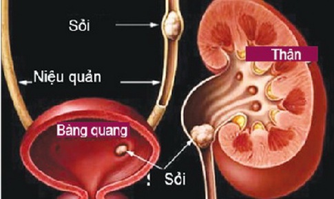 B&#224;i thuốc điều trị sỏi tiết niệu