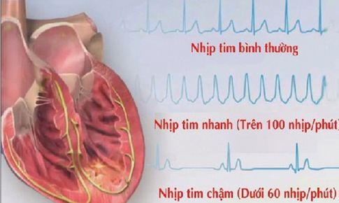 B&#224;i thuốc chữa trị nhịp tim chậm