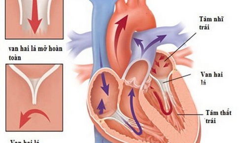 Nguy cơ do hở van động mạch chủ