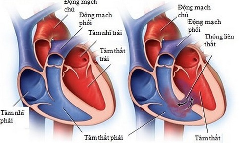 Những lưu &#253; về bệnh th&#244;ng li&#234;n thất