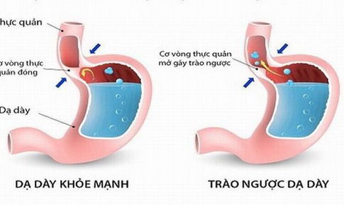 C&#225;ch n&#224;o ngủ tốt với chứng tr&#224;o ngược dạ d&#224;y?