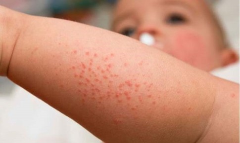 Cách phân biệt sởi với các phát ban dạng sởi