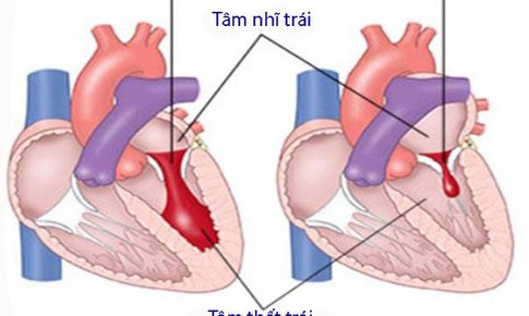 Dấu hiệu bệnh van hai l&#225; do thấp