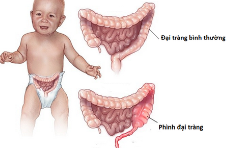 Ph&#236;nh đại tr&#224;ng - Bệnh dễ gặp ở trẻ nhỏ