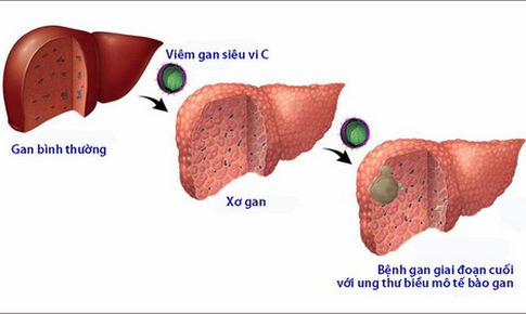 Hiểu đ&#250;ng về vi&#234;m gan mạn t&#237;nh