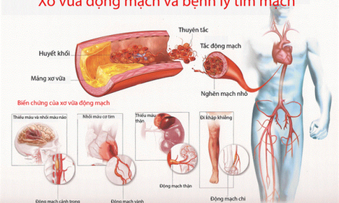 Một số chứng bệnh tim nguy hiểm thường gặp